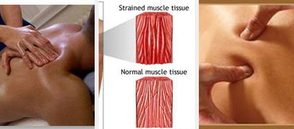Strained muscle tissue